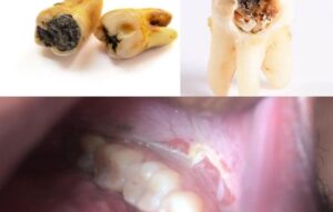 tooth extraction and treatment
