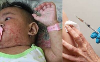 Rubeola Plague Hits Texas: Challenge killer to Nation Unprepared vaccination for Rubeola Plague in Texas